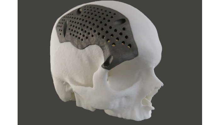 direct metal laser sintering dmls skull