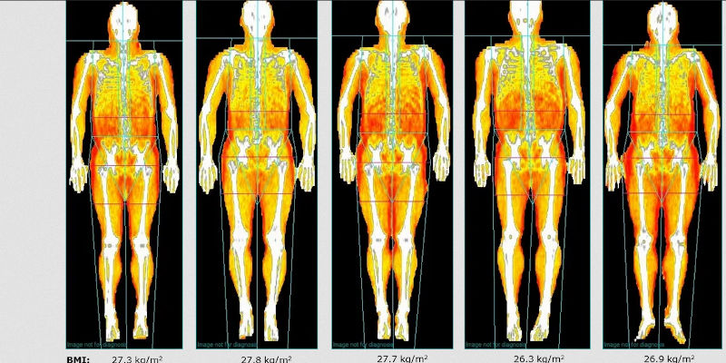 DEXA Scan